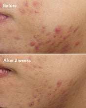Cargar imagen en el visor de la galería, MURAD DEEP RELIEF BLEMISH
