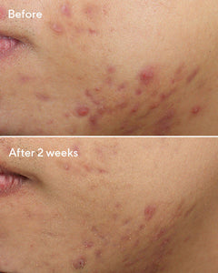 MURAD DEEP RELIEF BLEMISH